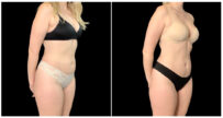 EMSCULPT® in London Ontario before and after result