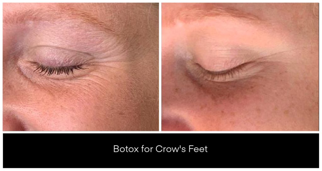 BOTOX® and Dysport® Treatments in London Ontario before and after result