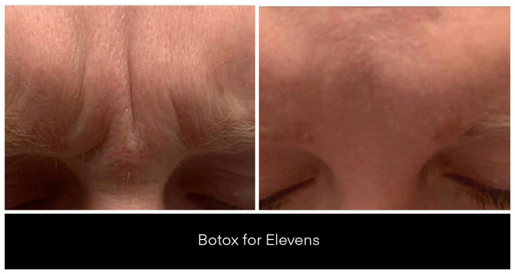 BOTOX® and Dysport® Treatments in London Ontario before and after result