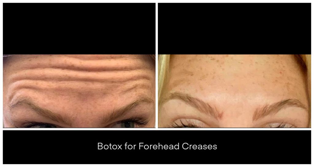 BOTOX® and Dysport® Treatments in London Ontario before and after result