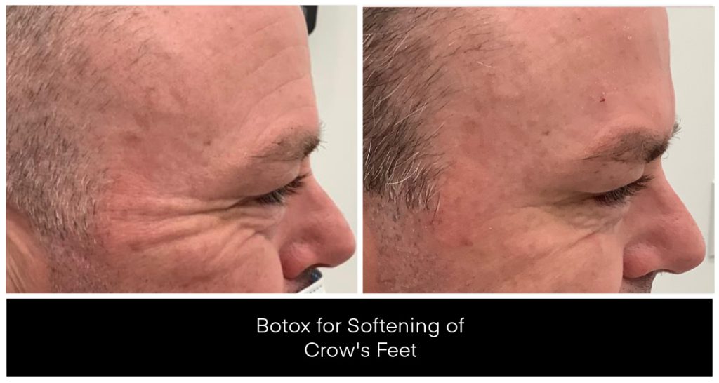 Profile view of a man with crow’s feet showing reduced eye-area wrinkles after BOTOX treatment; Botox crow’s feet improvement in London Ontario