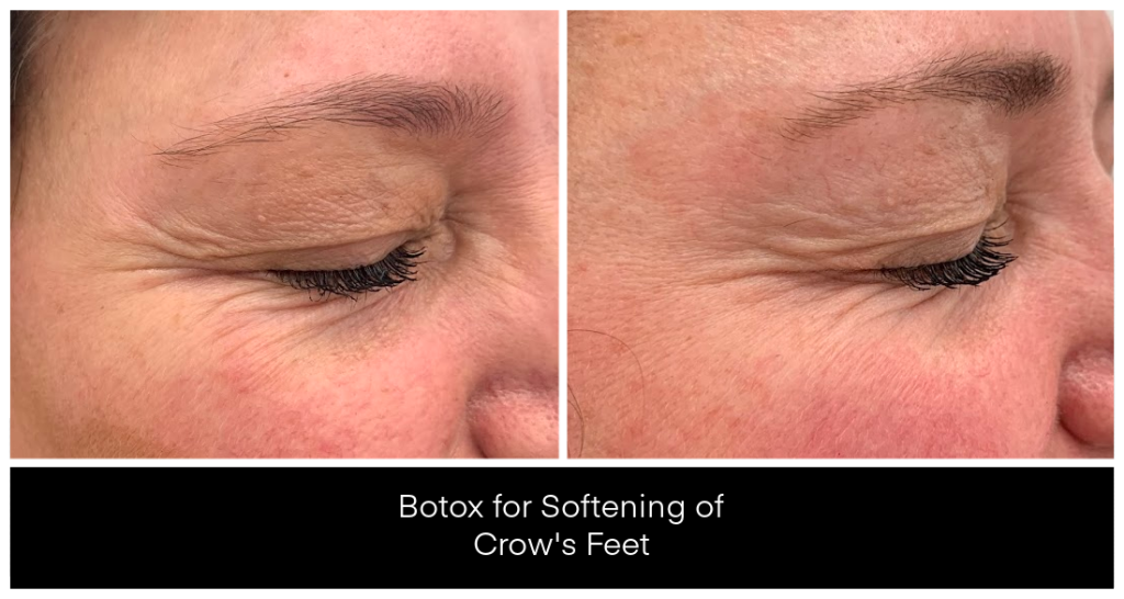 BOTOX® and Dysport® Treatments in London Ontario before and after result