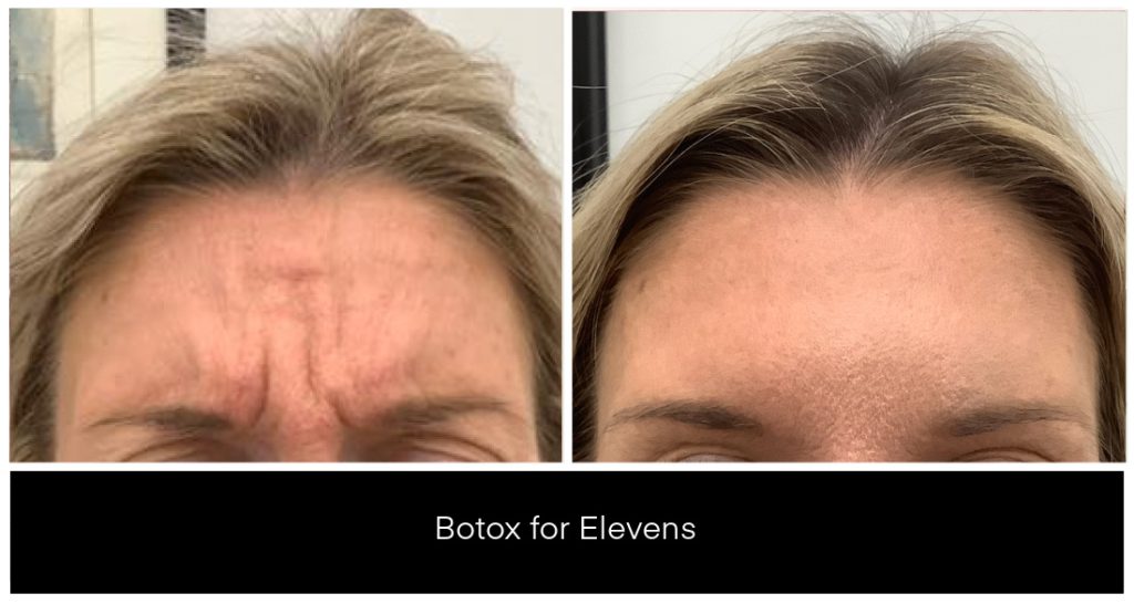 Botox Elevens forehead wrinkle treatment before-and-after image, highlighting BOTOX® results on deep frown lines with Dysport®-related context and a professional aesthetic clinic setting.