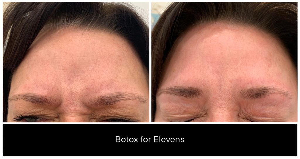 BOTOX® and Dysport® Treatments in London Ontario before and after result