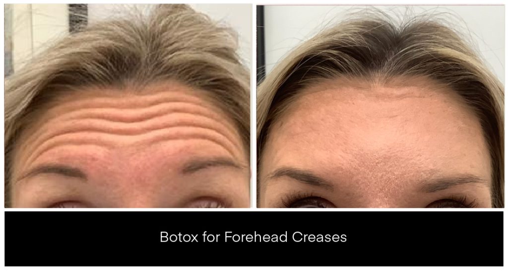 Botox forehead treatment results showing reduced forehead creases on a client; close-up of smooth forehead and natural expression at Yazdani Aesthetics