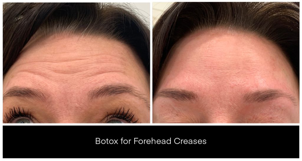 BOTOX® and Dysport® Treatments in London Ontario before and after result