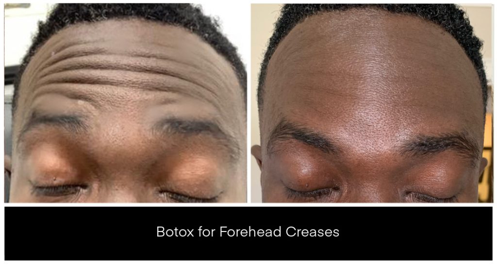 Botox forehead creases before-and-after comparison on a dark-skinned client, highlighting reduced forehead wrinkles and smoothened brow area with clear texture details.