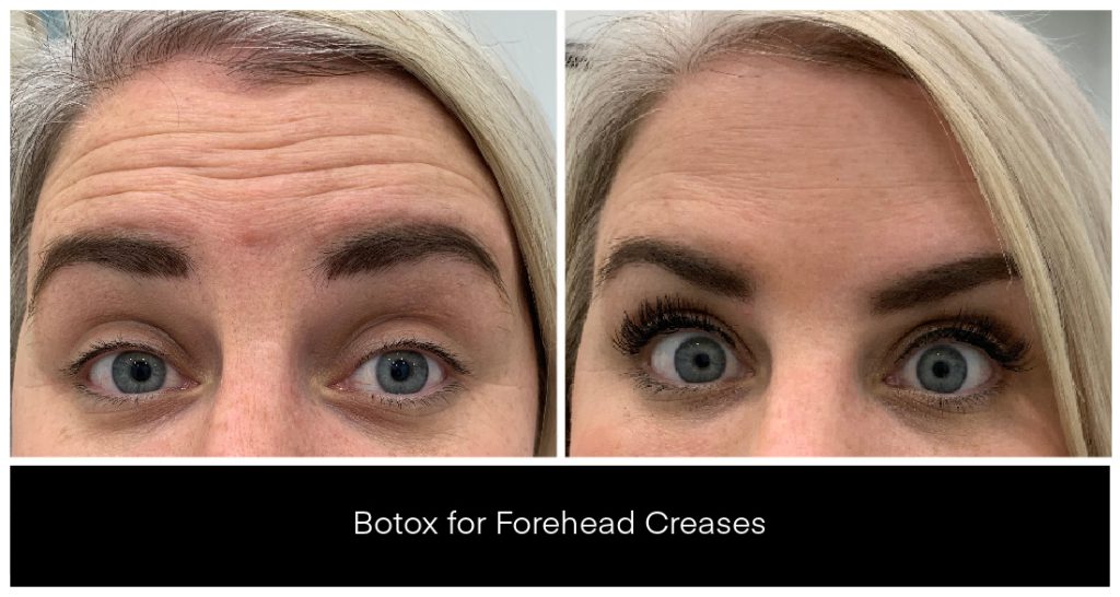 BOTOX® and Dysport® Treatments in London Ontario before and after result