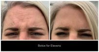 BOTOX® and Dysport® Treatments in London Ontario before and after result