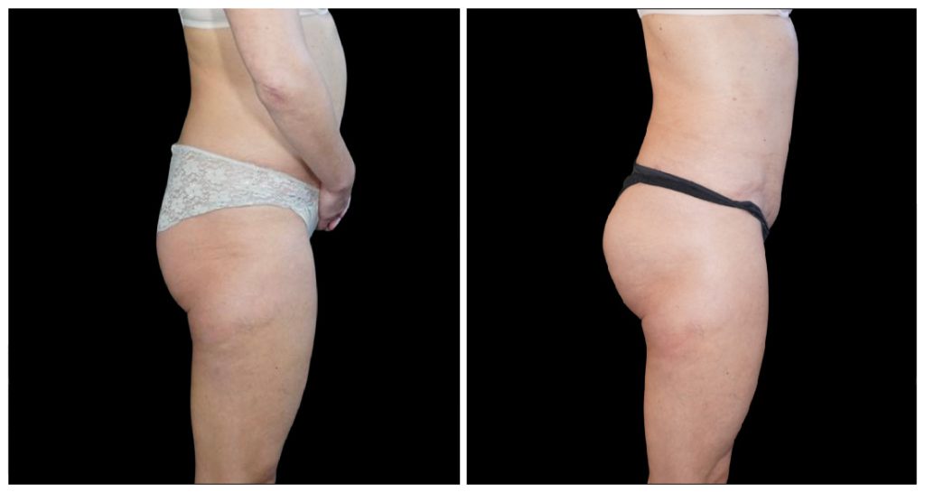 Brazilian Butt Lift before and after result