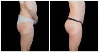 Brazilian Butt Lift before and after result