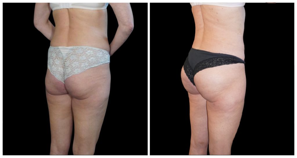 Brazilian Butt Lift before and after result