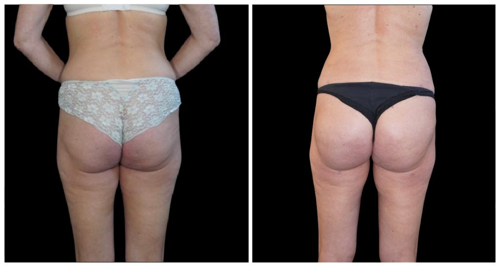 Brazilian Butt Lift before and after result