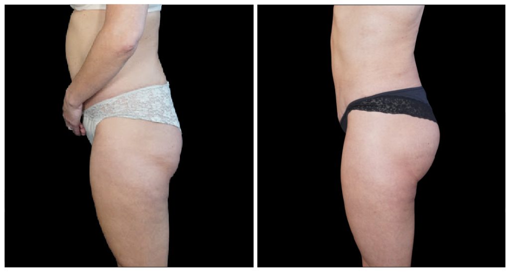 Brazilian Butt Lift before and after result