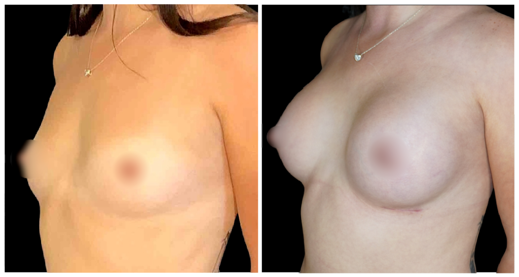 Breast Augmentation in London Ontario before and after result