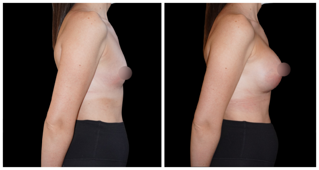 Breast Augmentation in London Ontario before and after result