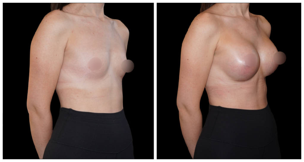 Breast Augmentation in London Ontario before and after result