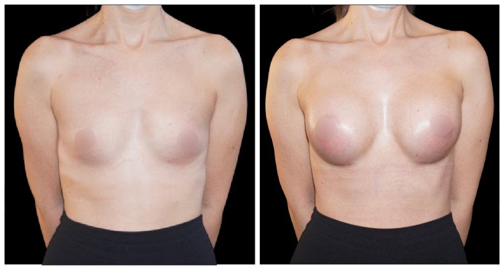 Breast Augmentation in London Ontario before and after result