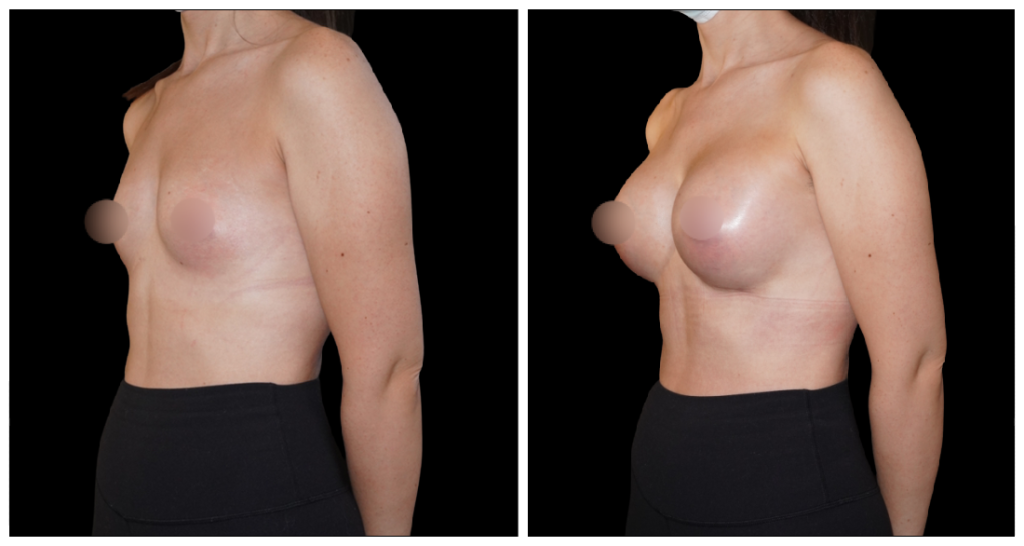 Breast Augmentation in London Ontario before and after result