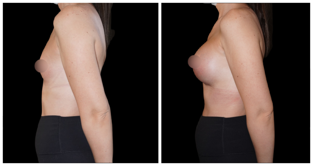 Breast Augmentation in London Ontario before and after result