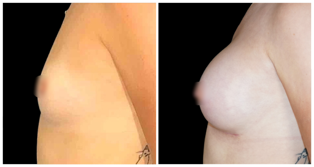 Breast Augmentation in London Ontario before and after result