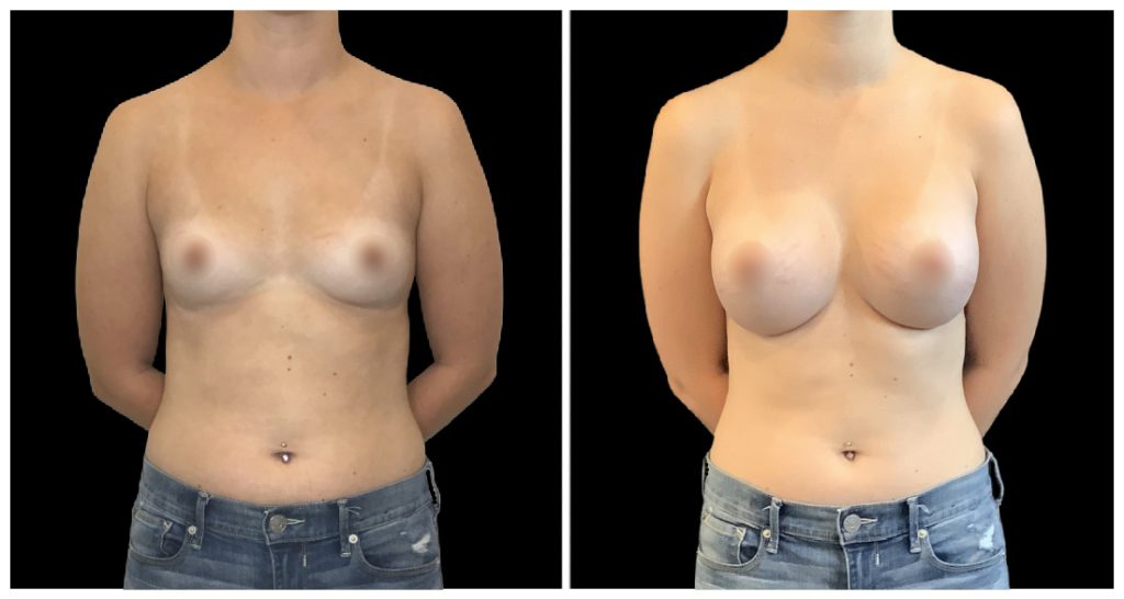 Breast Augmentation in London Ontario before and after result