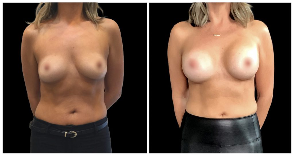 Breast Augmentation in London Ontario before and after result