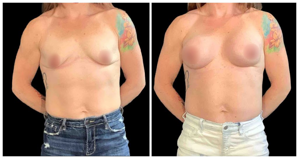 Breast Augmentation in London Ontario before and after result