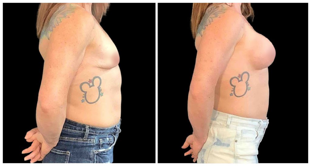 Breast Augmentation in London Ontario before and after result