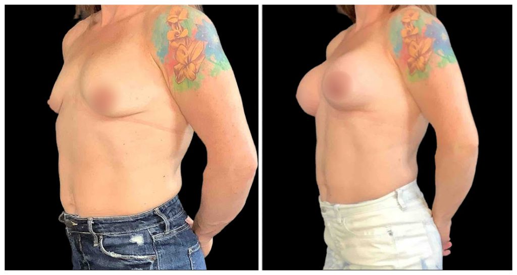 Breast Augmentation in London Ontario before and after result