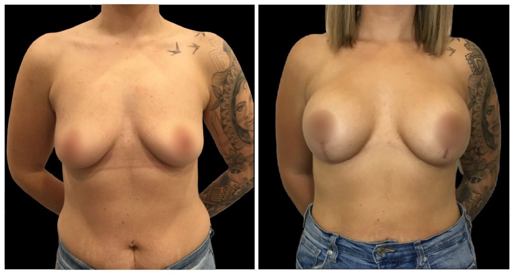 Breast Augmentation in London Ontario before and after result