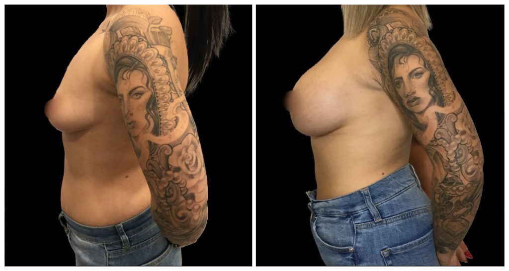 Breast Augmentation in London Ontario before and after result