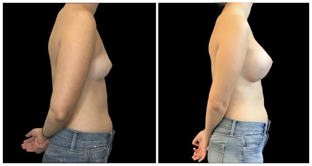 Breast Augmentation in London Ontario before and after result