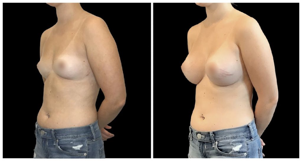 Breast Augmentation in London Ontario before and after result