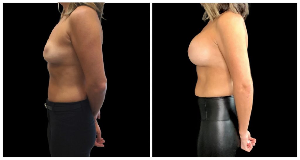 Breast Augmentation in London Ontario before and after result