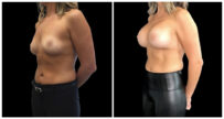 Breast Augmentation in London Ontario before and after result