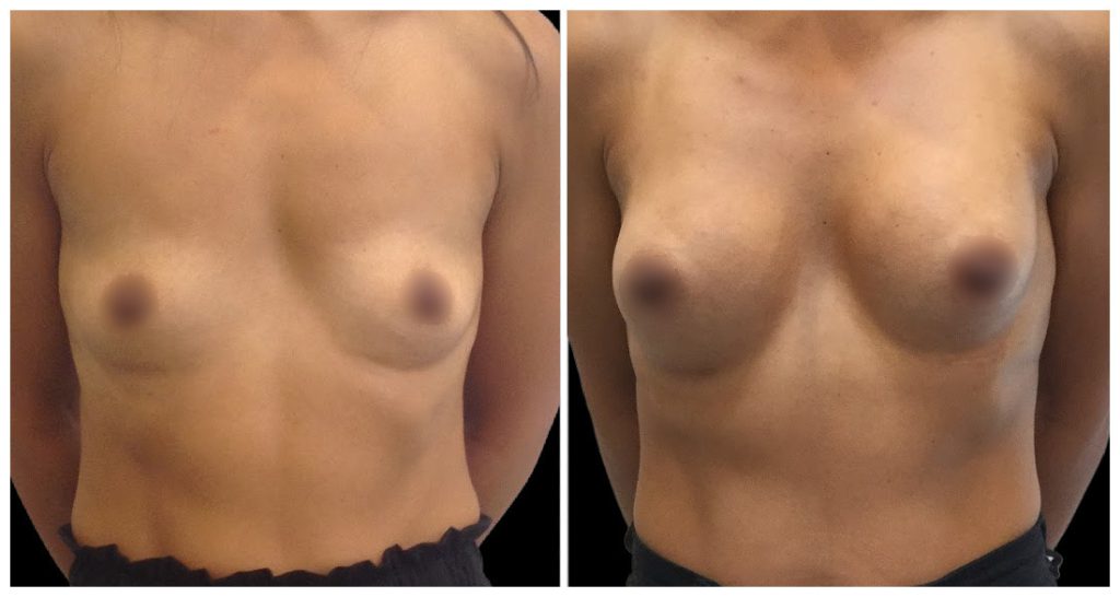 Breast Augmentation in London Ontario before and after result