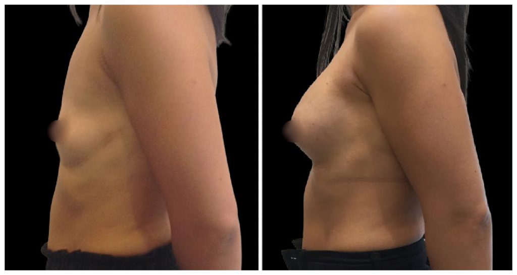 Breast Augmentation in London Ontario before and after result