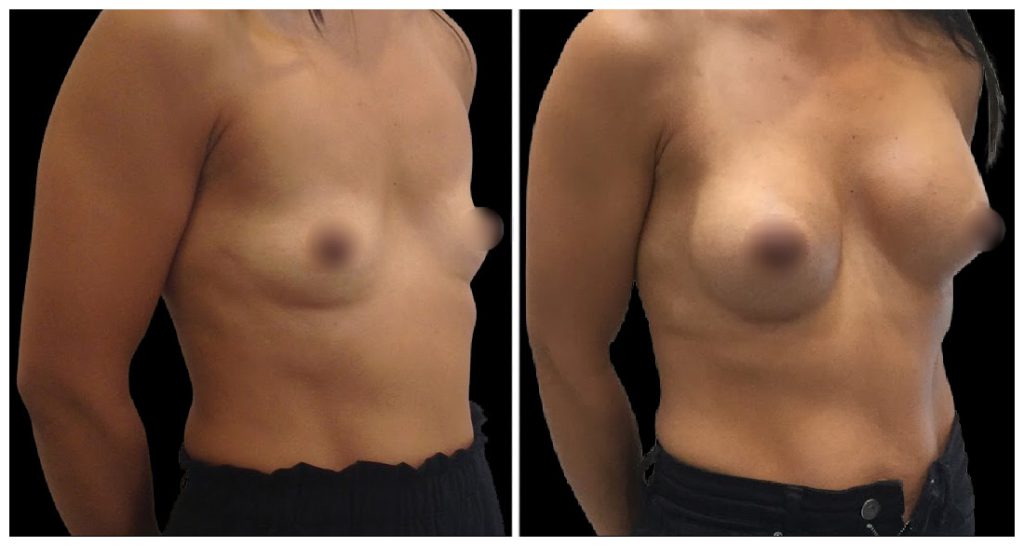 Breast Augmentation in London Ontario before and after result