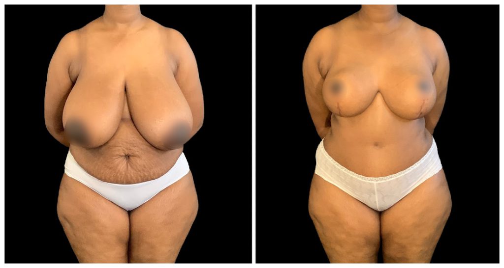 Breast Reduction before and after result