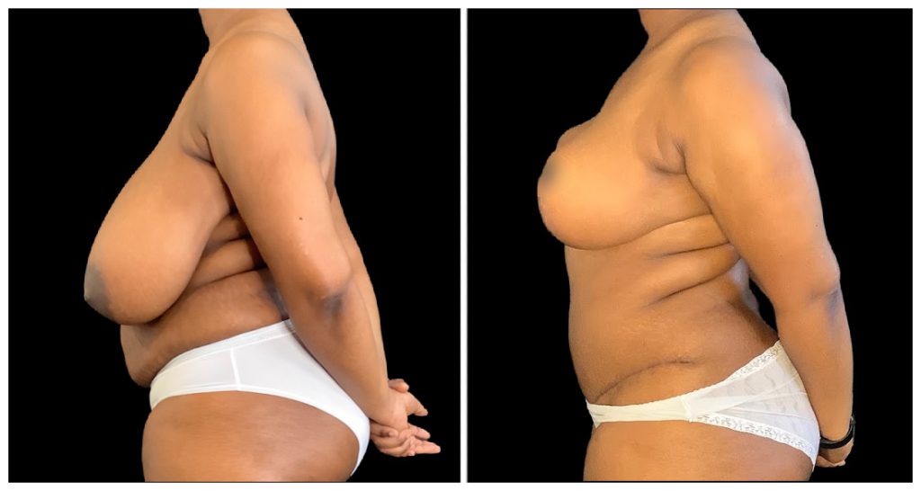 Breast Reduction before and after result
