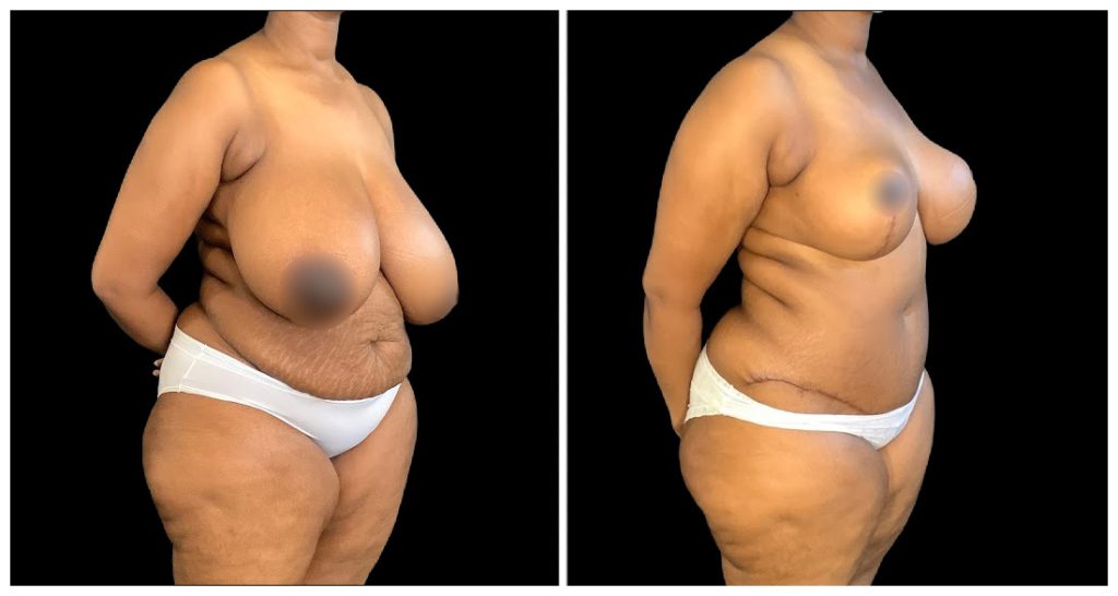 Breast Reduction before and after result