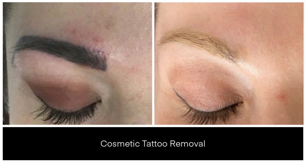 Before and after close-up of an eyebrow cosmetic tattoo showing laser tattoo removal progress and a lighter healed brow line after treatment.