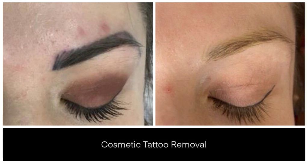Close-up brows show cosmetic tattoo removal progress at Yazdani Aesthetics with PicoSure Pro, softening dark eyebrow pigment on the skin after treatment.