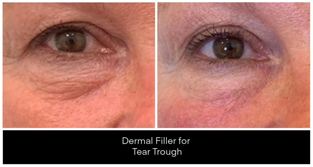 Dermal Filler in London Ontario before and after result