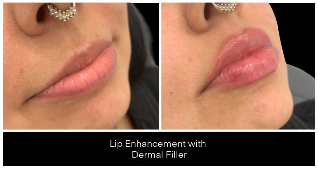 Dermal Filler in London Ontario before and after result