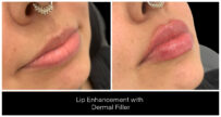 Dermal Filler in London Ontario before and after result