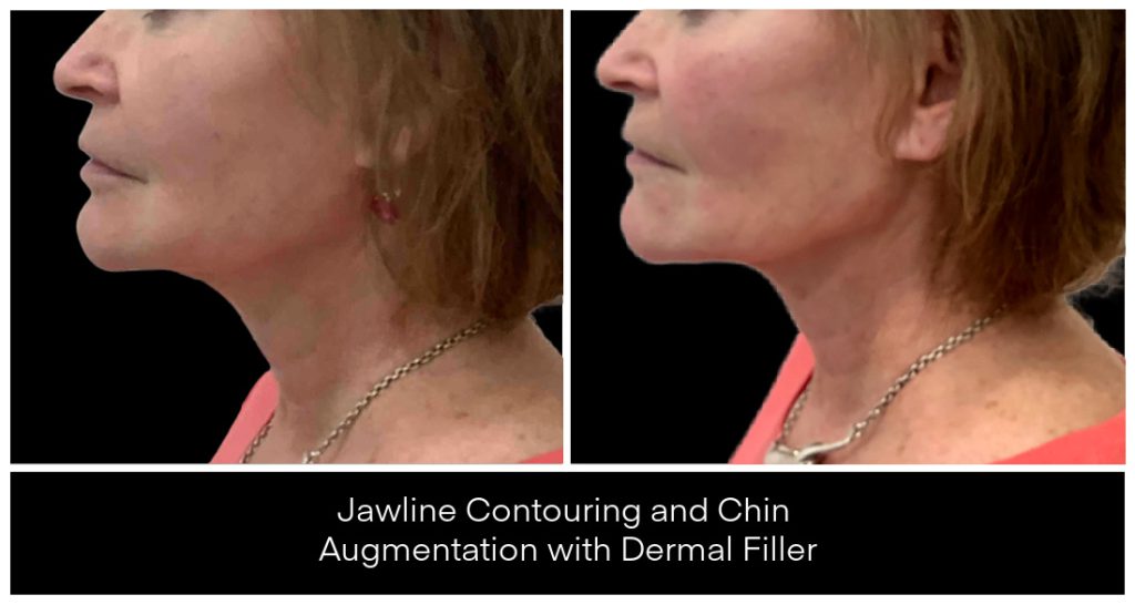 Dermal Filler in London Ontario before and after result