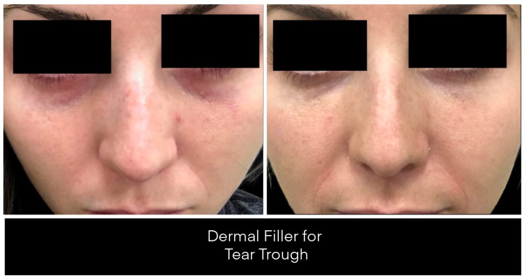 Dermal Filler in London Ontario before and after result
