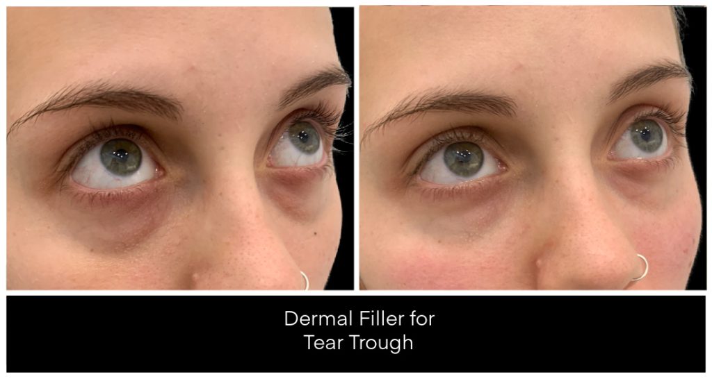 Dermal Filler in London Ontario before and after result